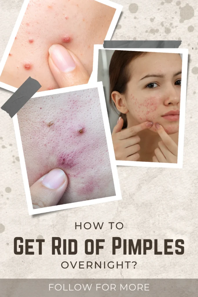 How to Get Rid of Pimples Overnight